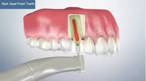 Root-Canal-Front-Tooth