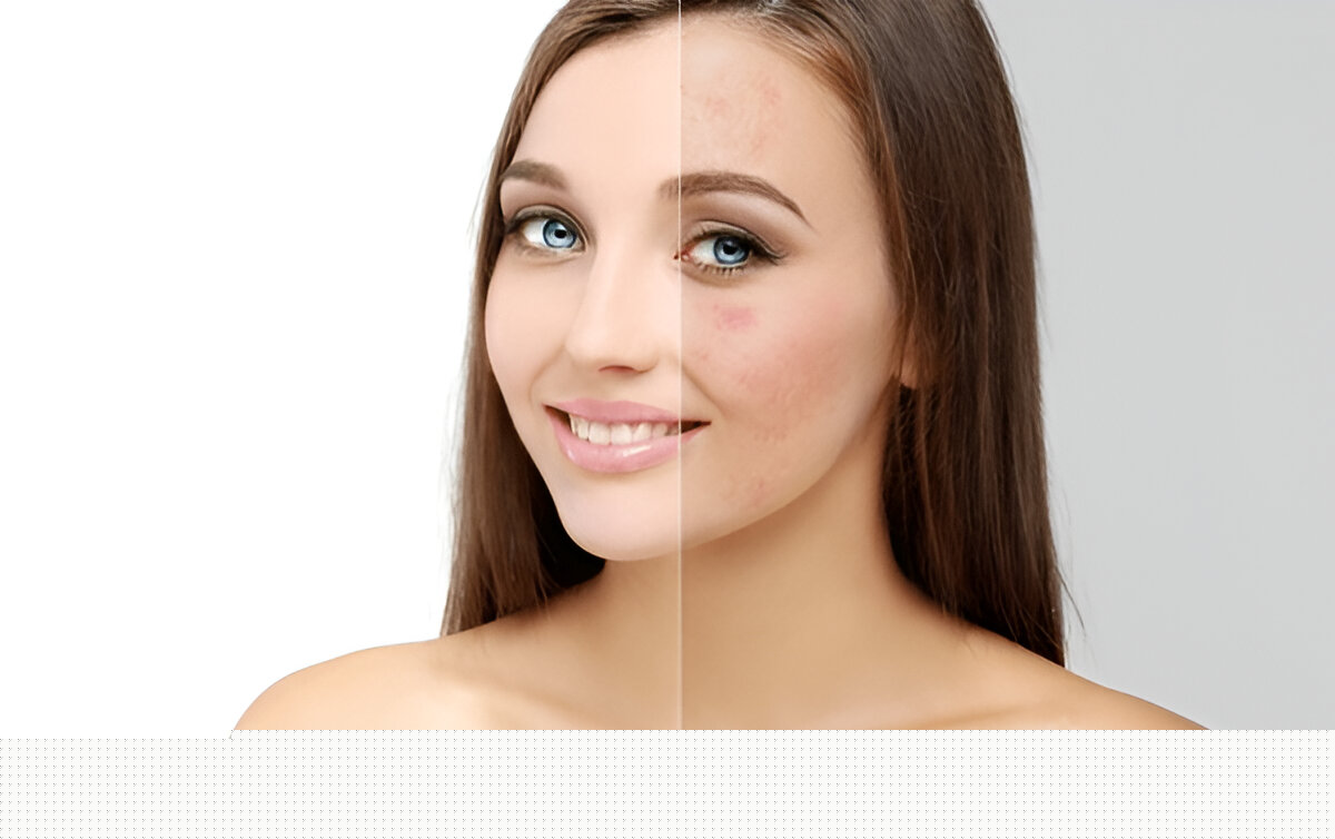 Pigmentation-Removal-Singapore