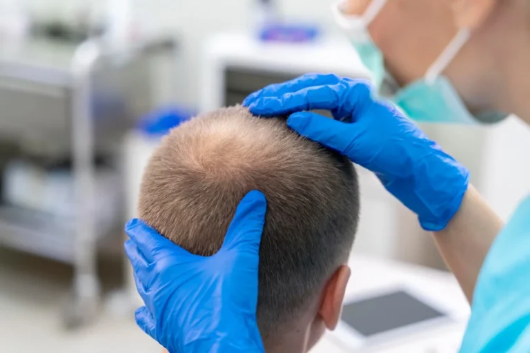 FUE-for-men-at-White-Hill-Clinic