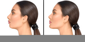 Nose-Augmentation-Singapore