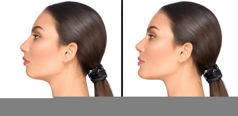 Nose-Augmentation-Singapore