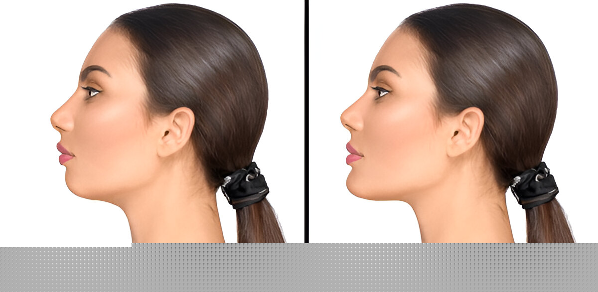 Nose-Augmentation-Singapore