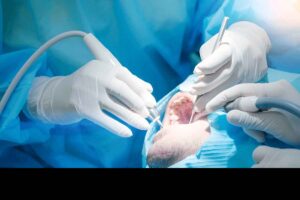 Wisdom-Tooth-Surgery
