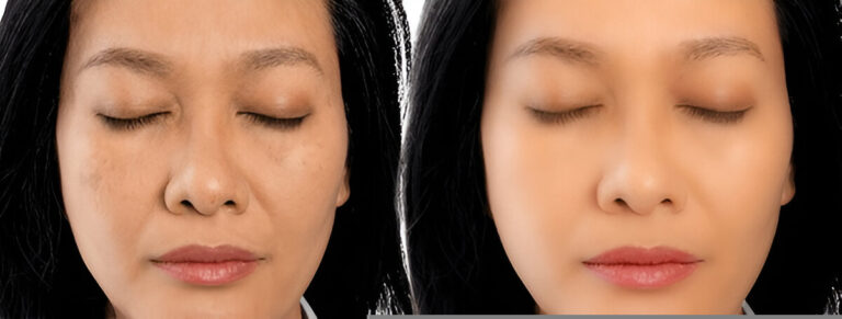 melasma-treatment