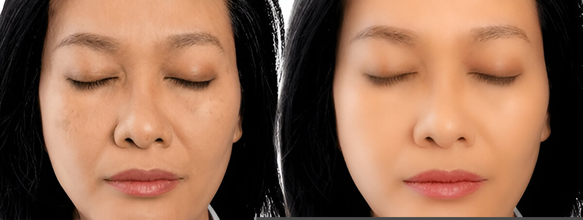 melasma-treatment