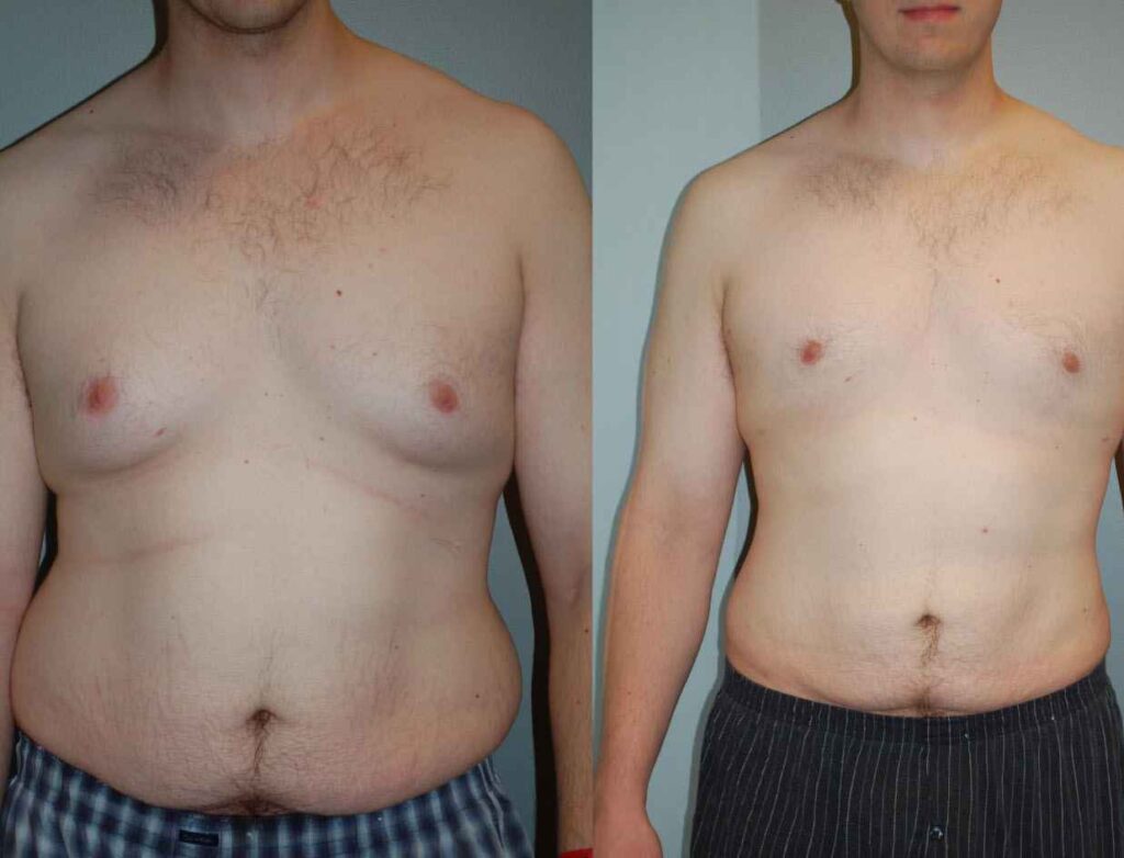 man-boobs-removal-treatment
