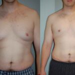 Man Boobs Removal: What Exactly Are the Benefits?