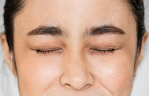 Signs You May Have Brow Ptosis