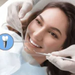 dental-implants-abroad